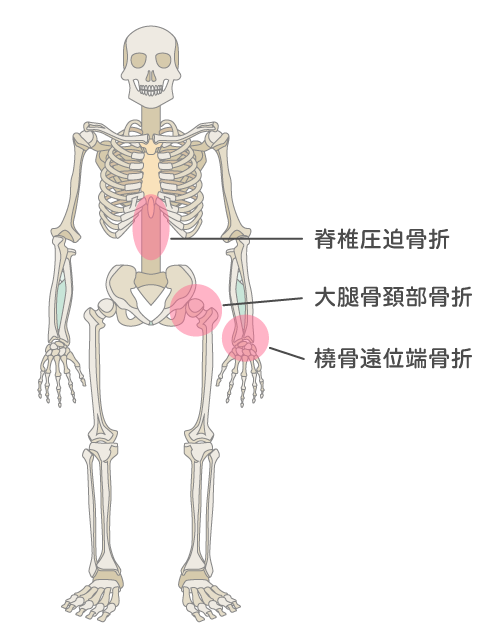 骨粗鬆症の治療 | 西田整形外科クリニック