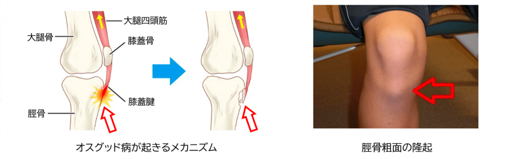 膝の痛み 西田整形外科クリニック